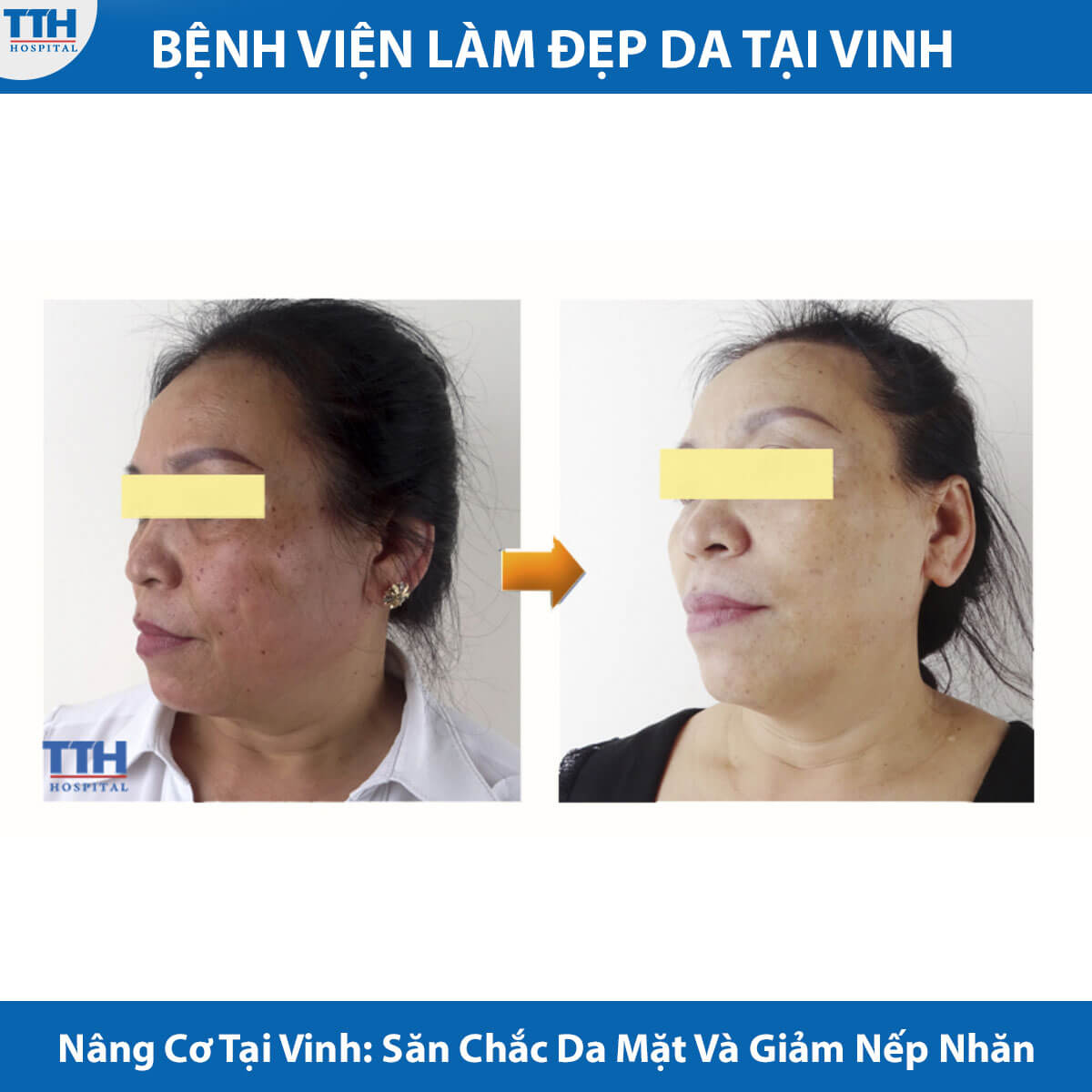 Nâng Cơ Tại Vinh: Săn Chắc Da Mặt Và Giảm Nếp Nhăn