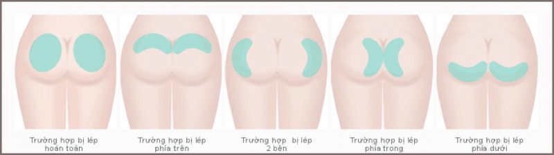  Đây là kỹ thuật thẩm mỹ vòng 3 toàn diện