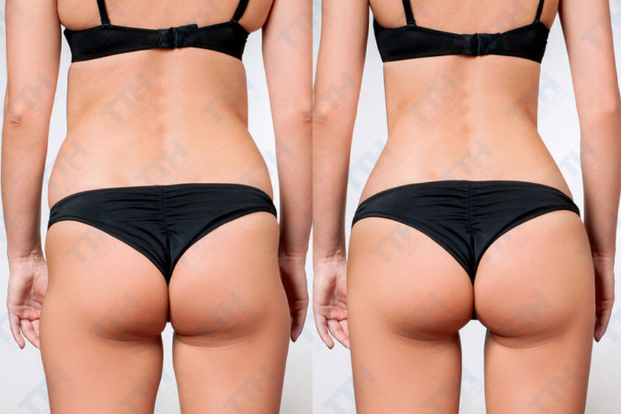 Nâng Mông Bằng Công Nghệ Body Jet Là Gì?