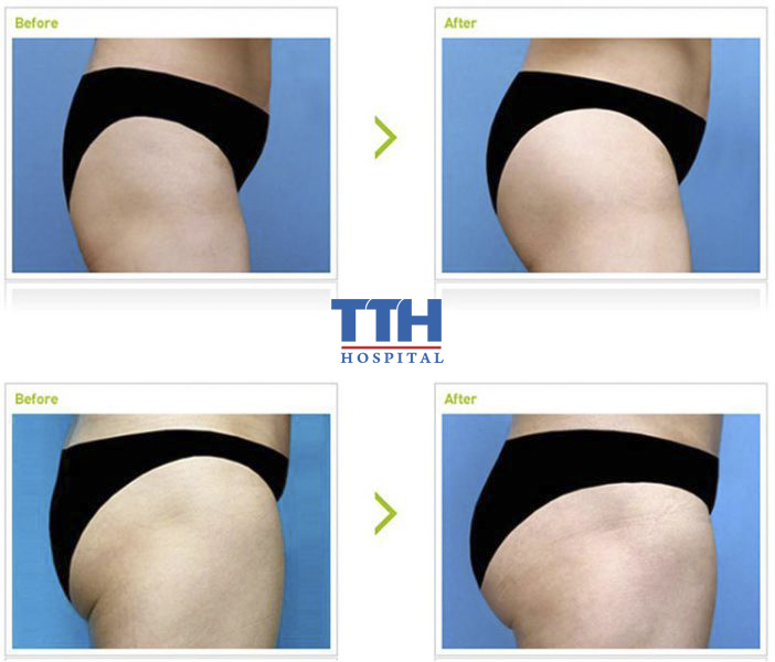Bác sĩ tiến hành đo vẽ hình dáng, kích thước mông trước khi phẫu thuật và tiến hành gây mê.