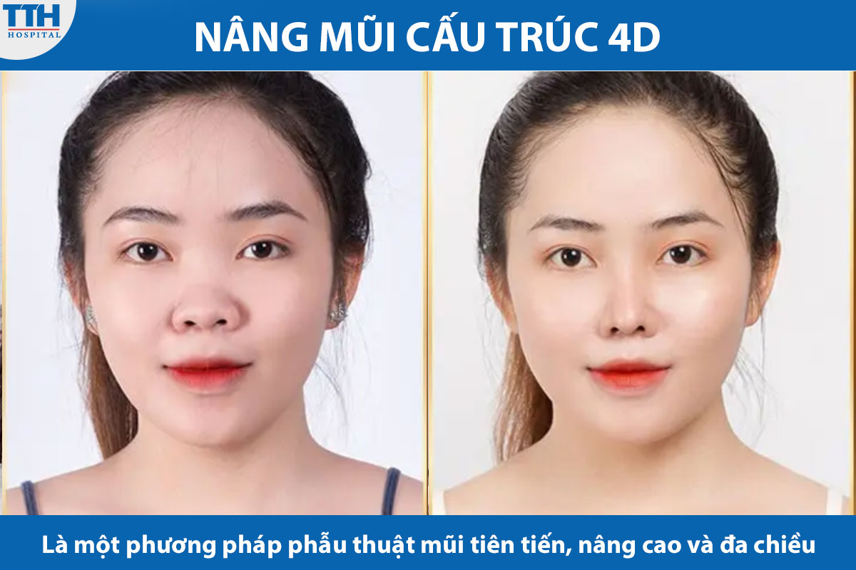 Nâng mũi cấu trúc là một phương pháp phẫu thuật mũi tiên tiến, nâng cao và đa chiều