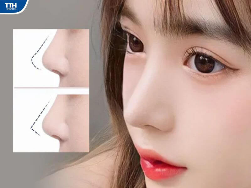 Nâng mũi cấu trúc là gì?