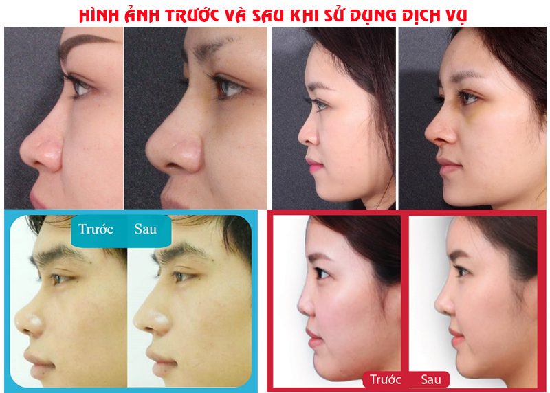 Quy trình nâng mũi không phẫu thuật tại Bệnh viện Thái Thượng Hoàng