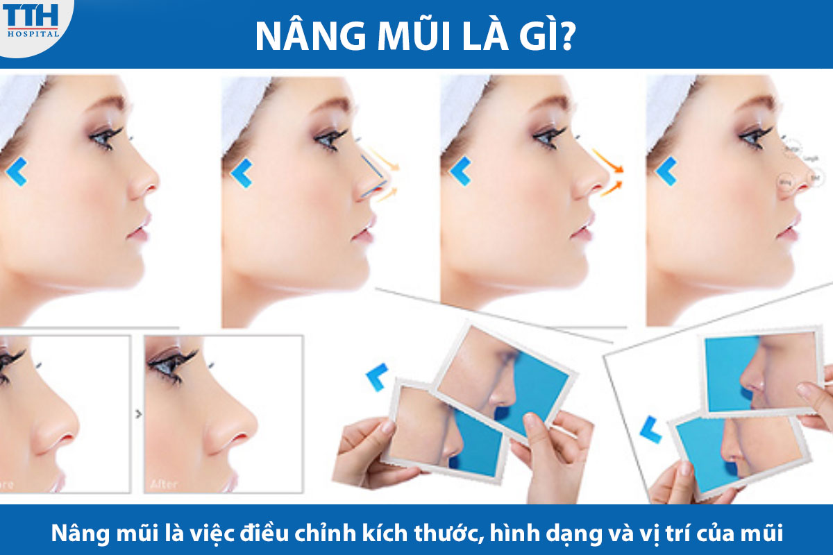 Nâng mũi là gì?