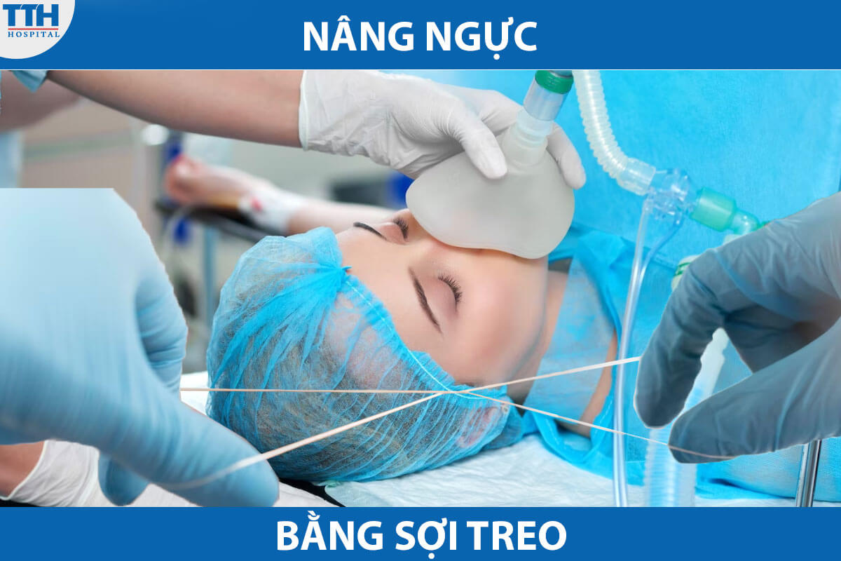 Nâng ngực bằng sợi treo