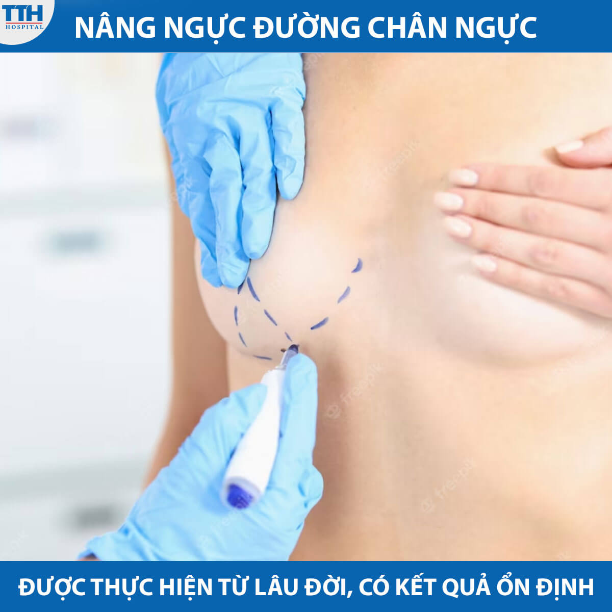 Nâng ngực đường chân ngực là phương pháp nâng ngực thông thường và đã được thực hiện từ lâu.