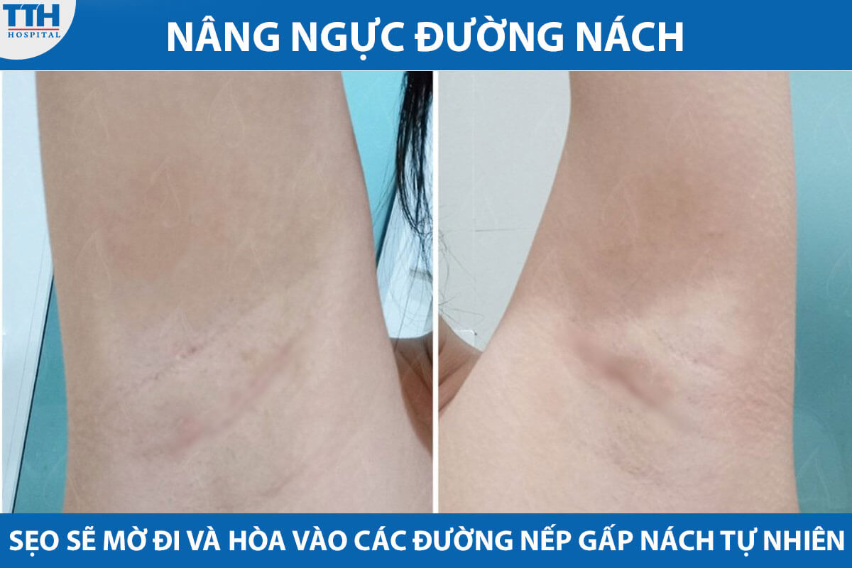 Nâng ngực đường nách thực hiện thông qua việc tạo các cắt nhỏ trên da, vì vậy không để lại sẹo lớn