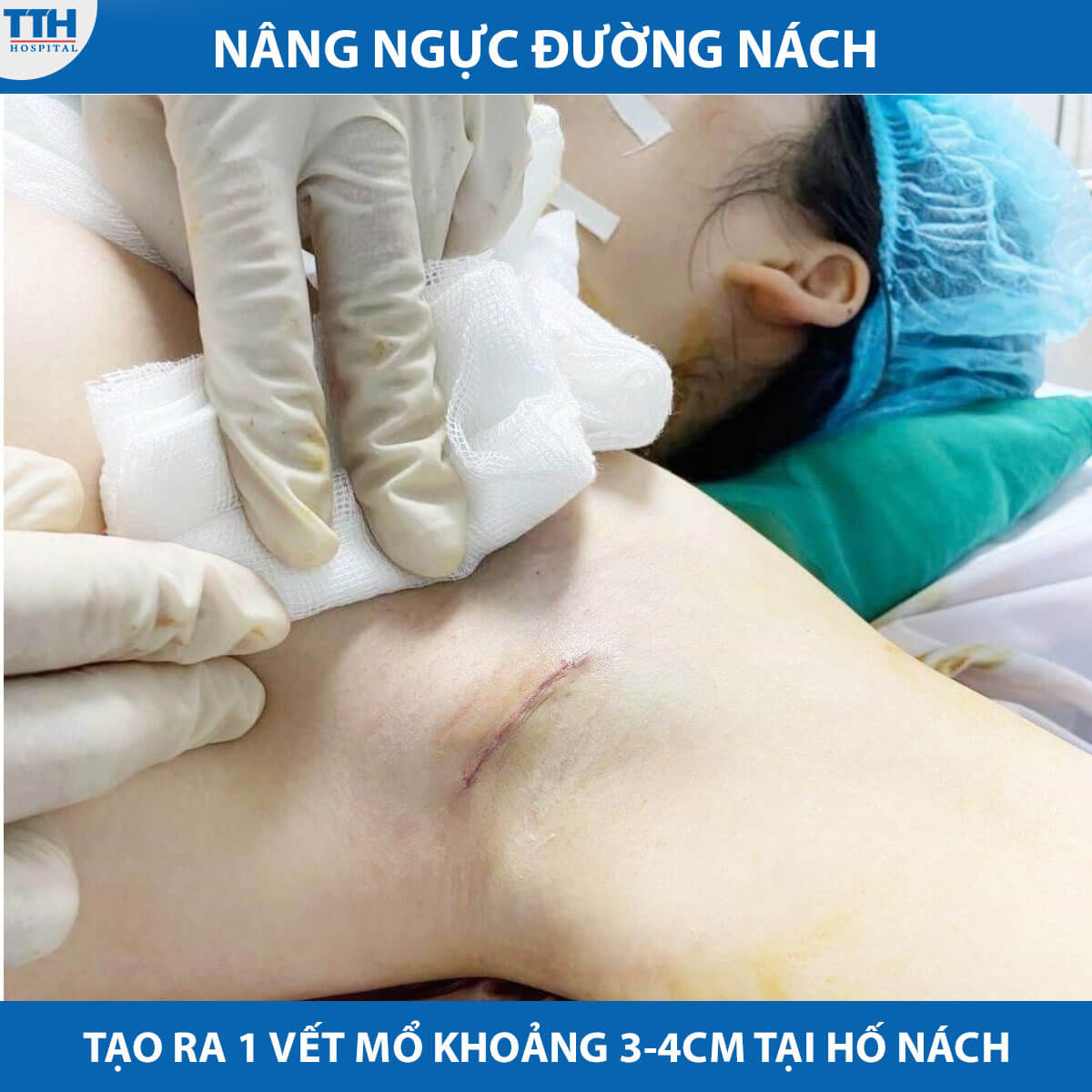 Nâng ngực đường nách là một trong những phương pháp nâng ngực phổ biến được nhiều phụ nữ ưa chuộng