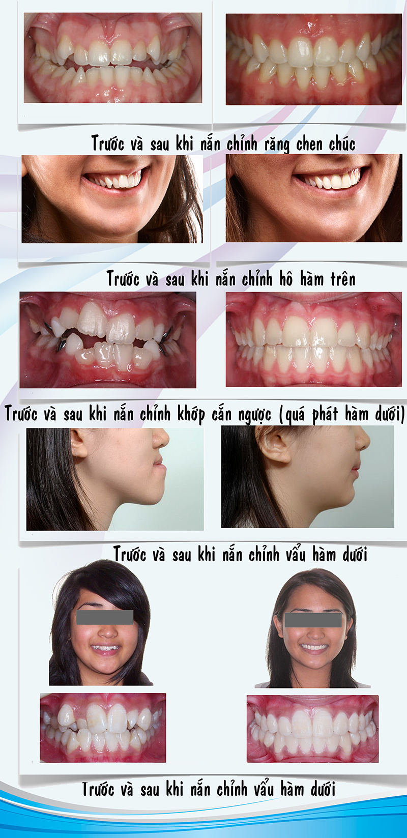 Nắn chỉnh răng mang lại thẩm mỹ khuôn mặt tối ưu nhất.
