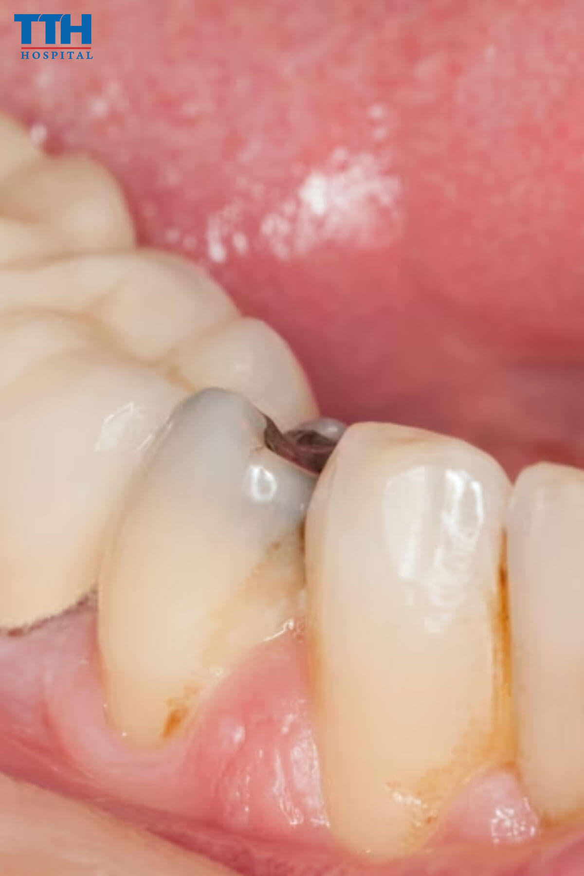 Người Có Vấn Đề Nặng về Răng Sâu không nên bọc răng sứ