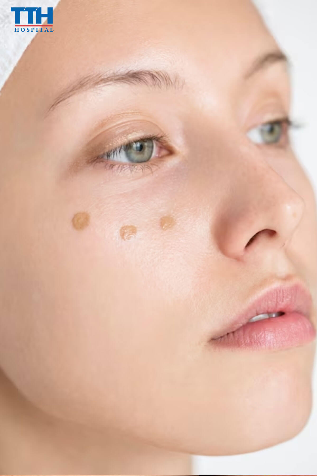 Nguyên nhân chính gây ra nám da sau sinh trị nám tại vinh nghệ An