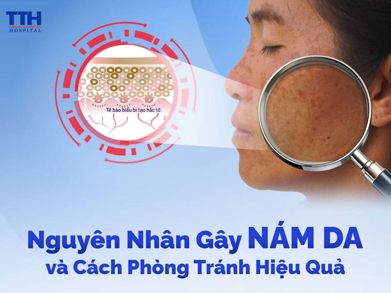 nguyên nhân gây nám da là gì?