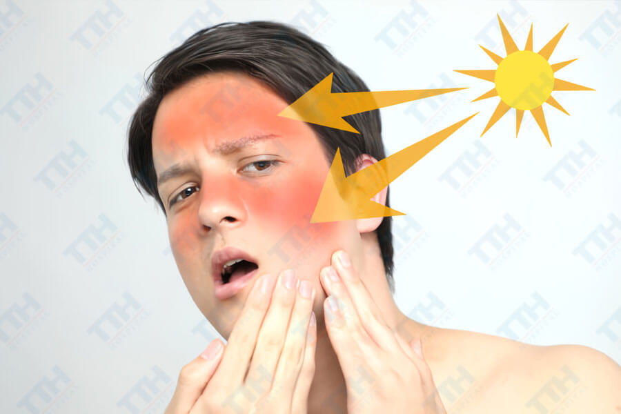Nguyên nhân gây nám da ở nam giới
