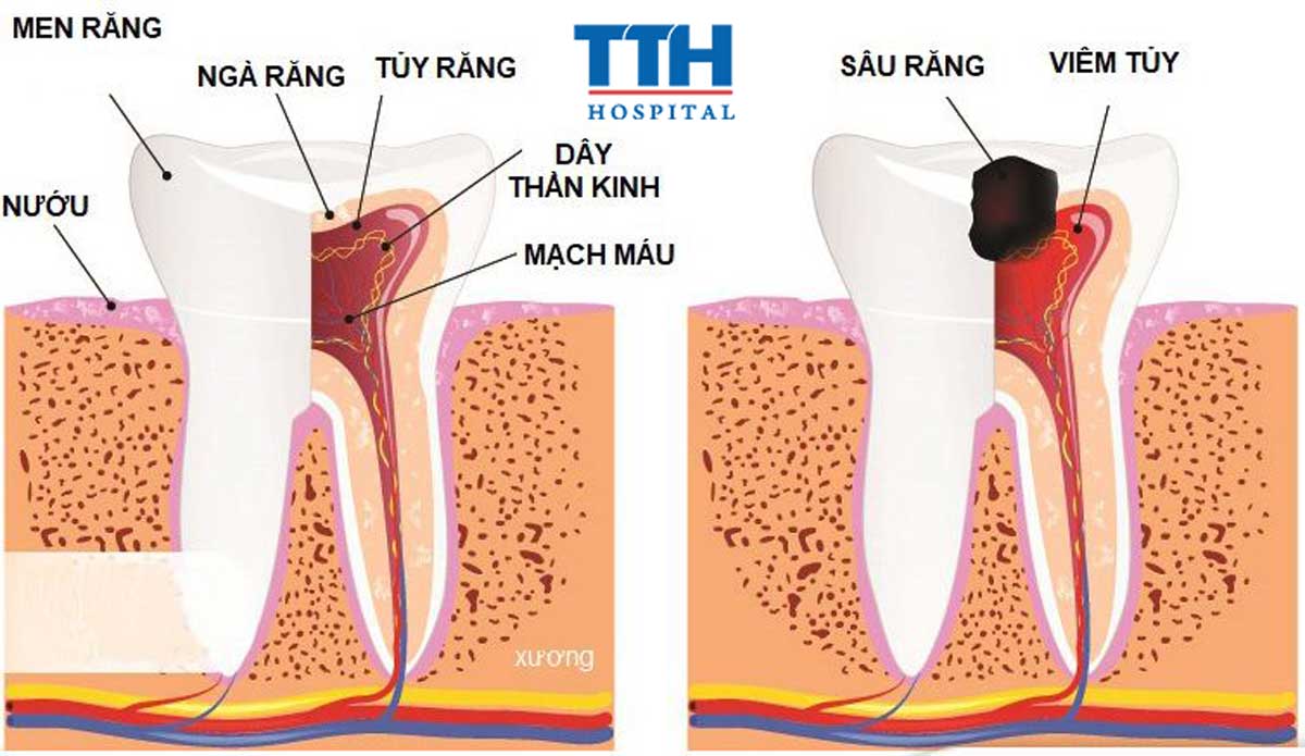 Nguyên nhân gây tổn thương tủy răng