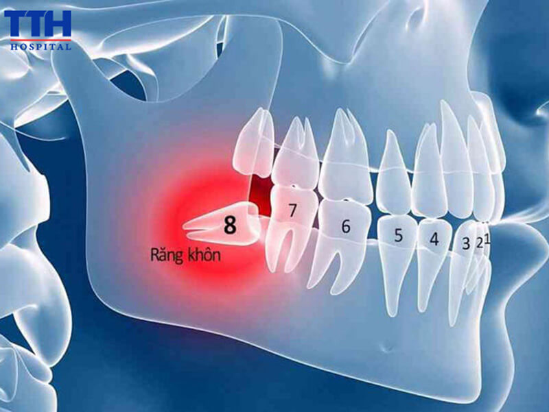 Nguyên nhân khiến răng khôn mọc lệch?