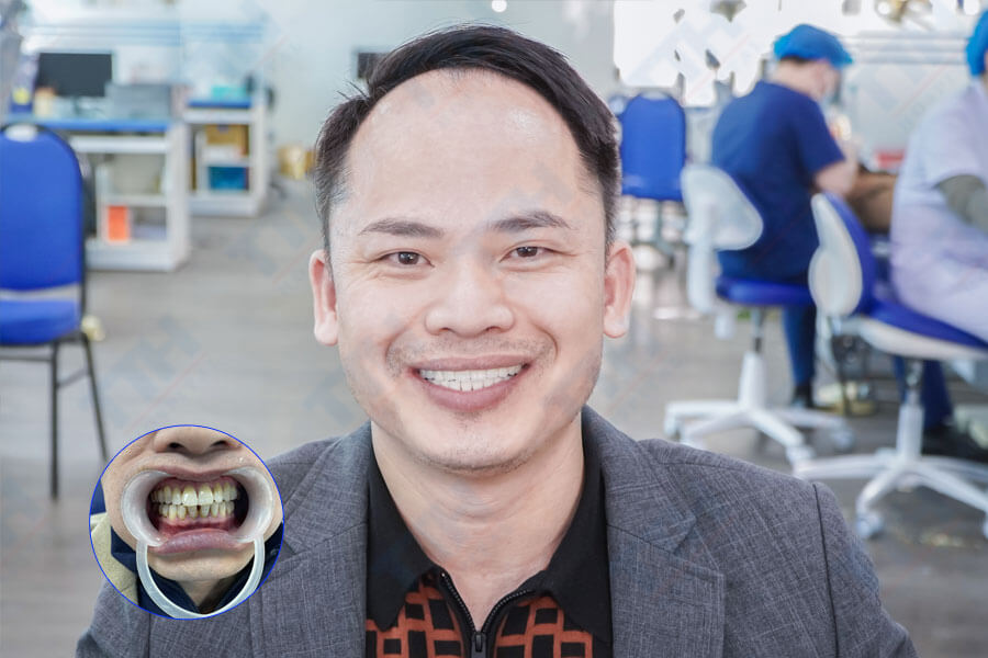 Tính An Toàn của Răng Sứ Zirconia