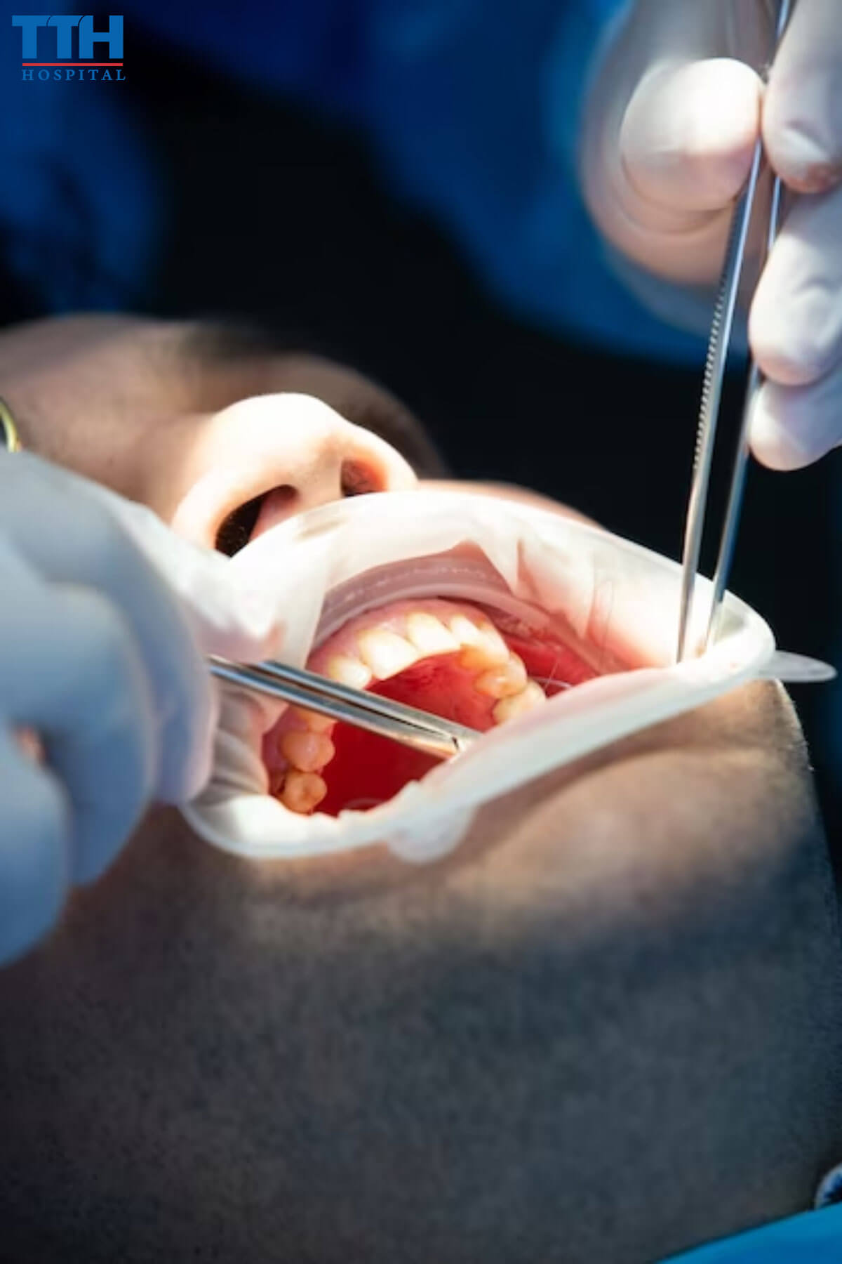 Nhổ Răng Khôn tại Vinh, Nghệ an là Gì?