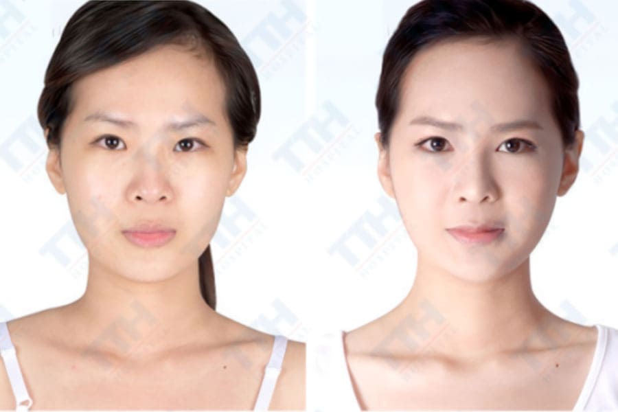 Những điều cần lưu ý khi độn thái dương