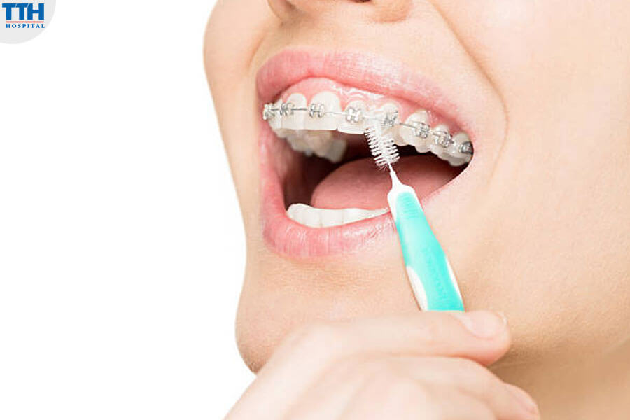 Những Điều Cần Lưu Ý Khi Sử Dụng Niềng Răng Mắc Cài Tự Buộc
