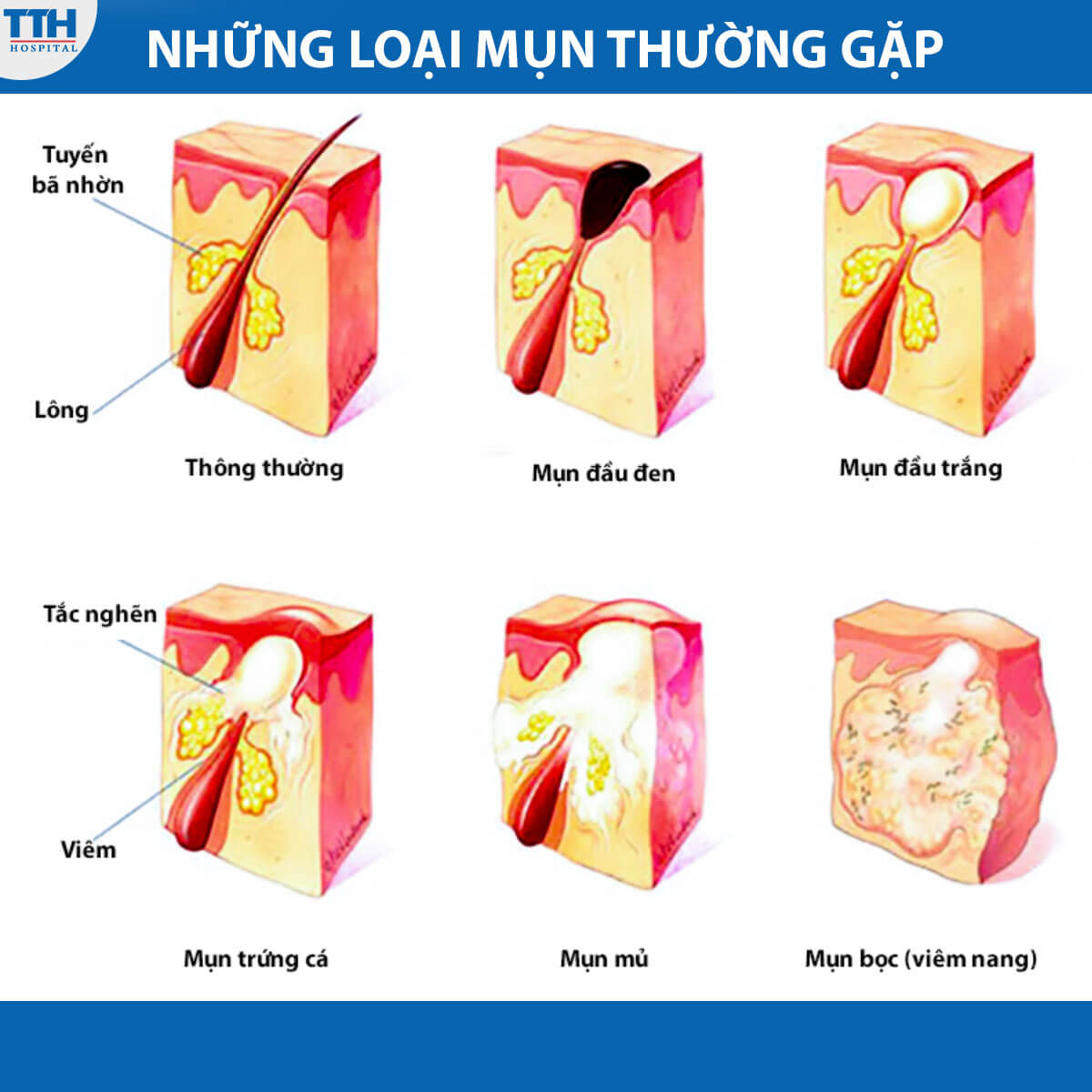 Những loại mụn thường gặp