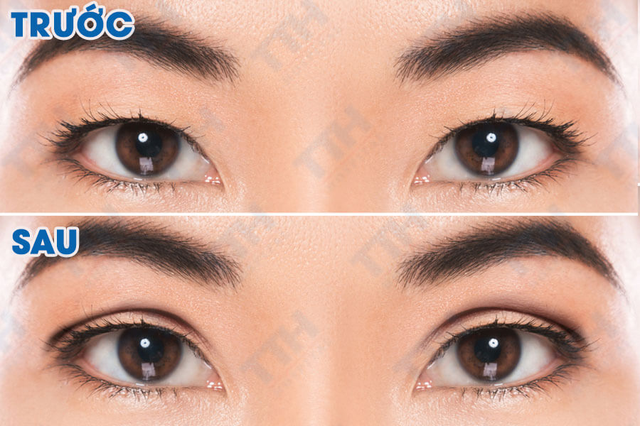 Những Lưu Ý Quan Trọng Của Phẫu thuật mí trên Perfect Eyes TTH