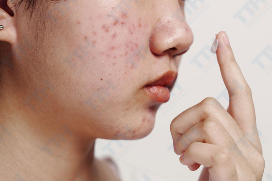 Những thay đổi của da trong giai đoạn dậy thì