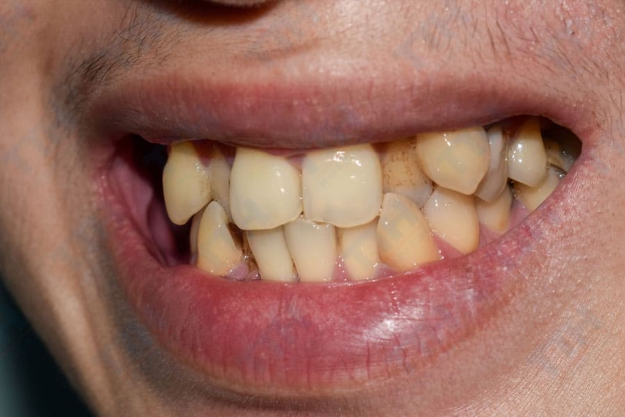 Những trường hợp nên bọc răng sứ