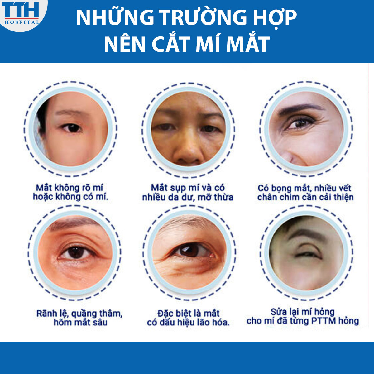 Những trường hợp nên cắt mí mắt