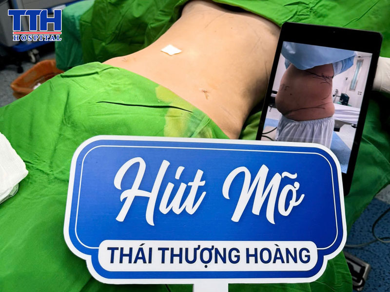 Những ưu điểm nổi bật của công nghệ hút mỡ Body-Jet