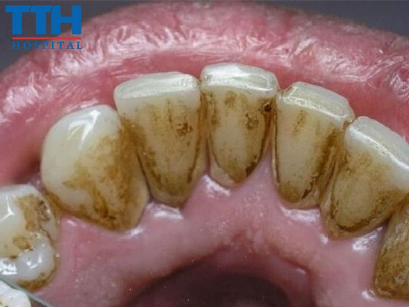 Những vấn đề về răng hàm mặt thường gặp phải sau Tết