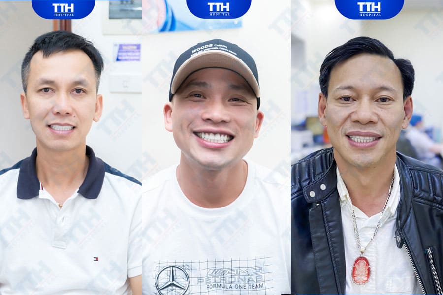Những yếu tố ảnh hưởng đến độ bền của Diamond Veneer