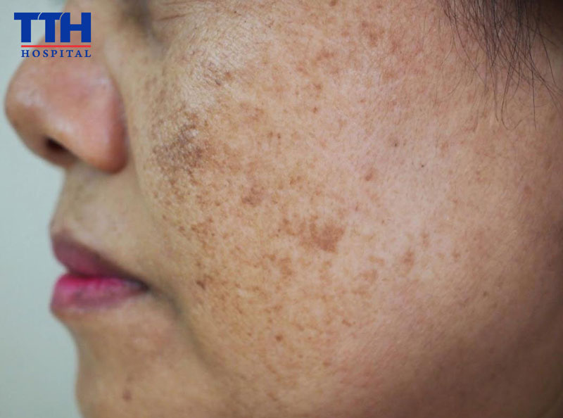 Những yếu tố quyết định số lần điều trị nám