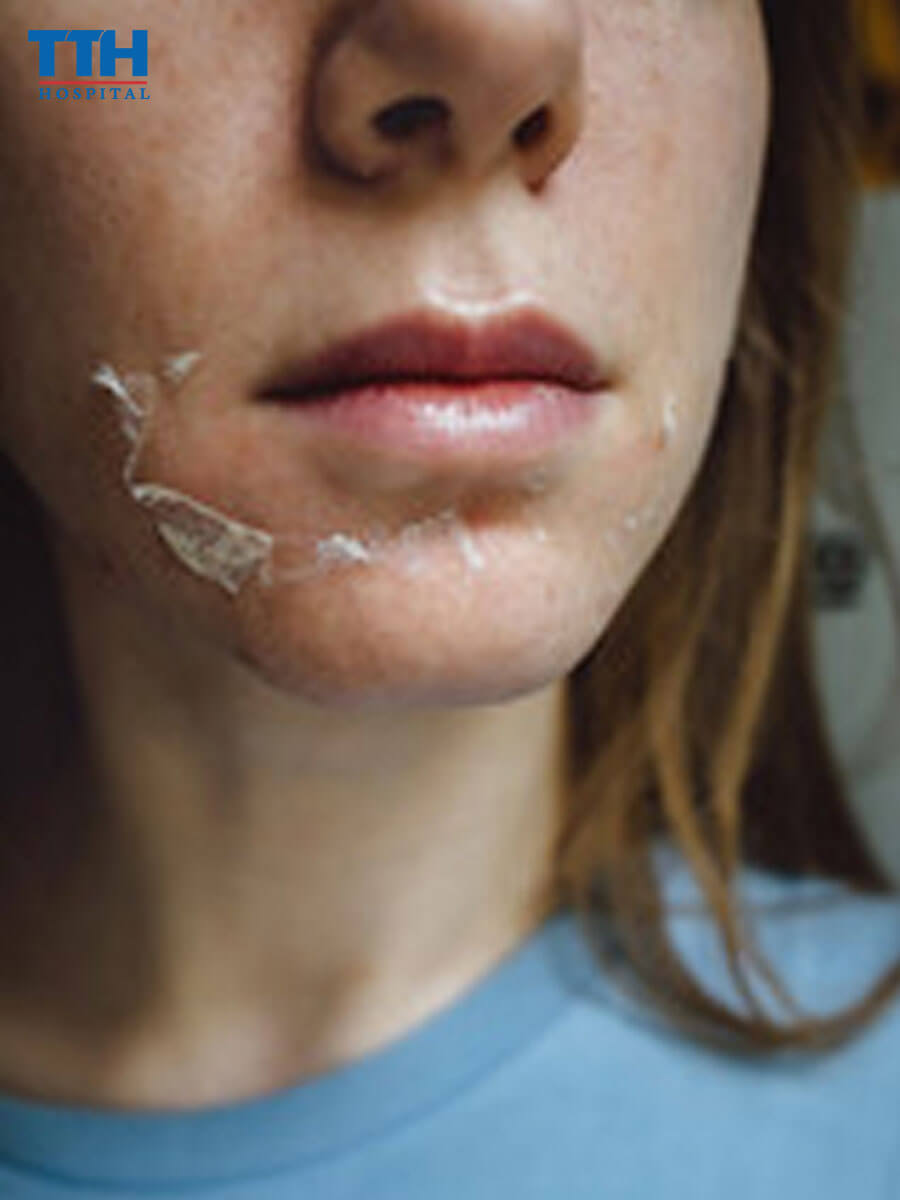 Nhược điểm của peel da tại Vinh Nghệ An