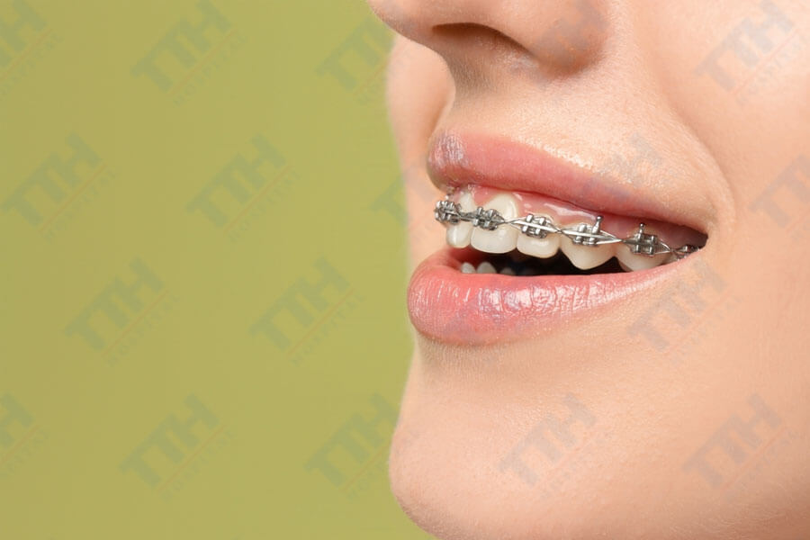 Niềng răng 1 hàm là gì?