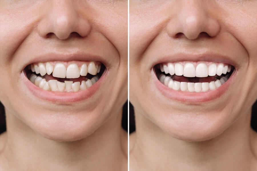 Niềng răng có thực sự gây hóp má?