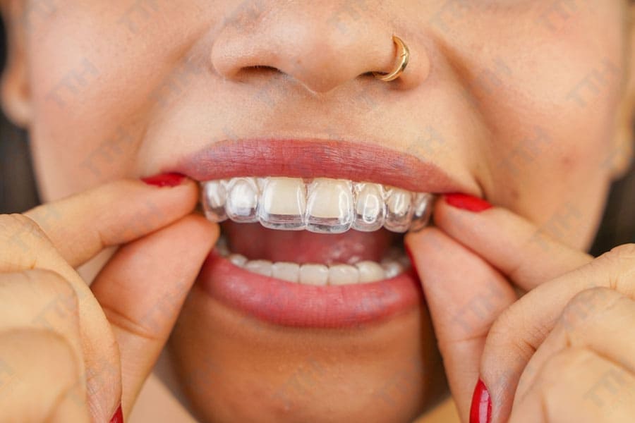 Niềng Răng Invisalign 1 Hàm Là Gì?