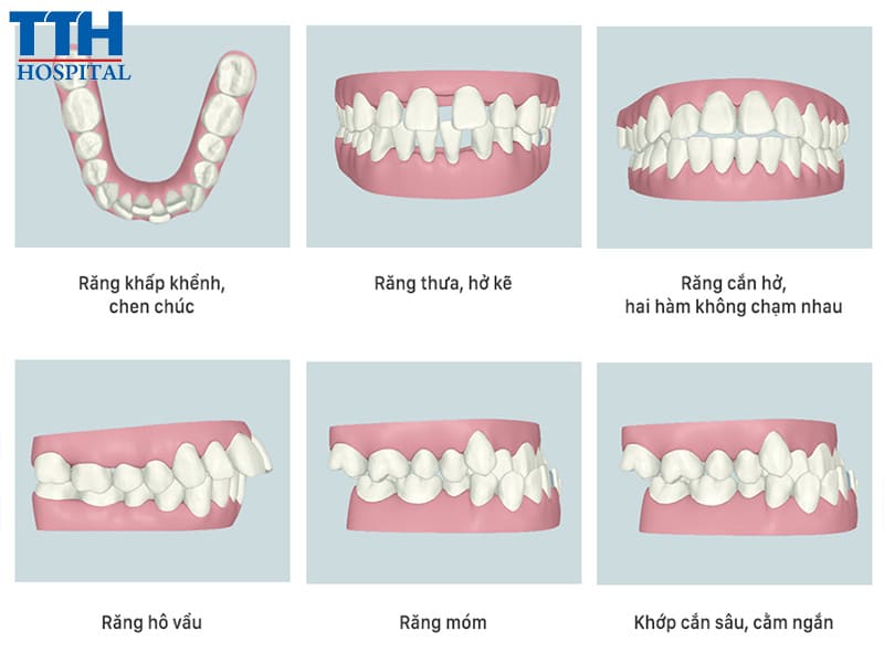 Niềng răng là gì?
