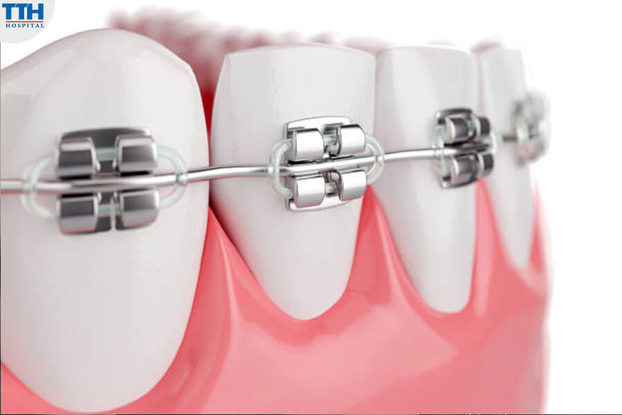 Niềng Răng Mắc Cài Tự Buộc Là Gì?