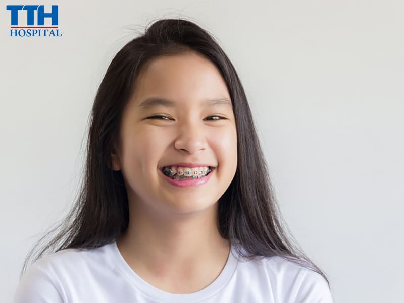 Niềng răng ở lứa tuổi trẻ