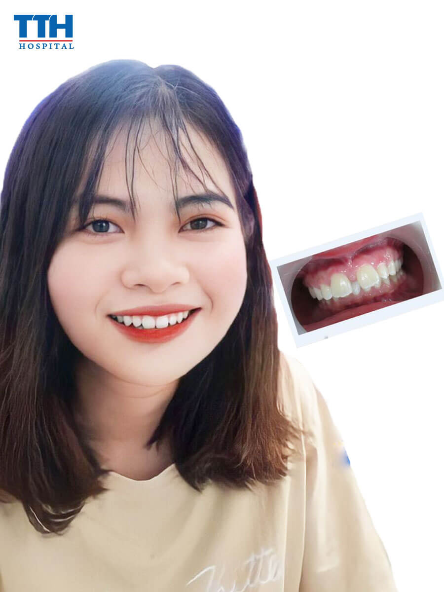 Niềng răng thưa ít đau đớn và nhanh hiệu quả nhất