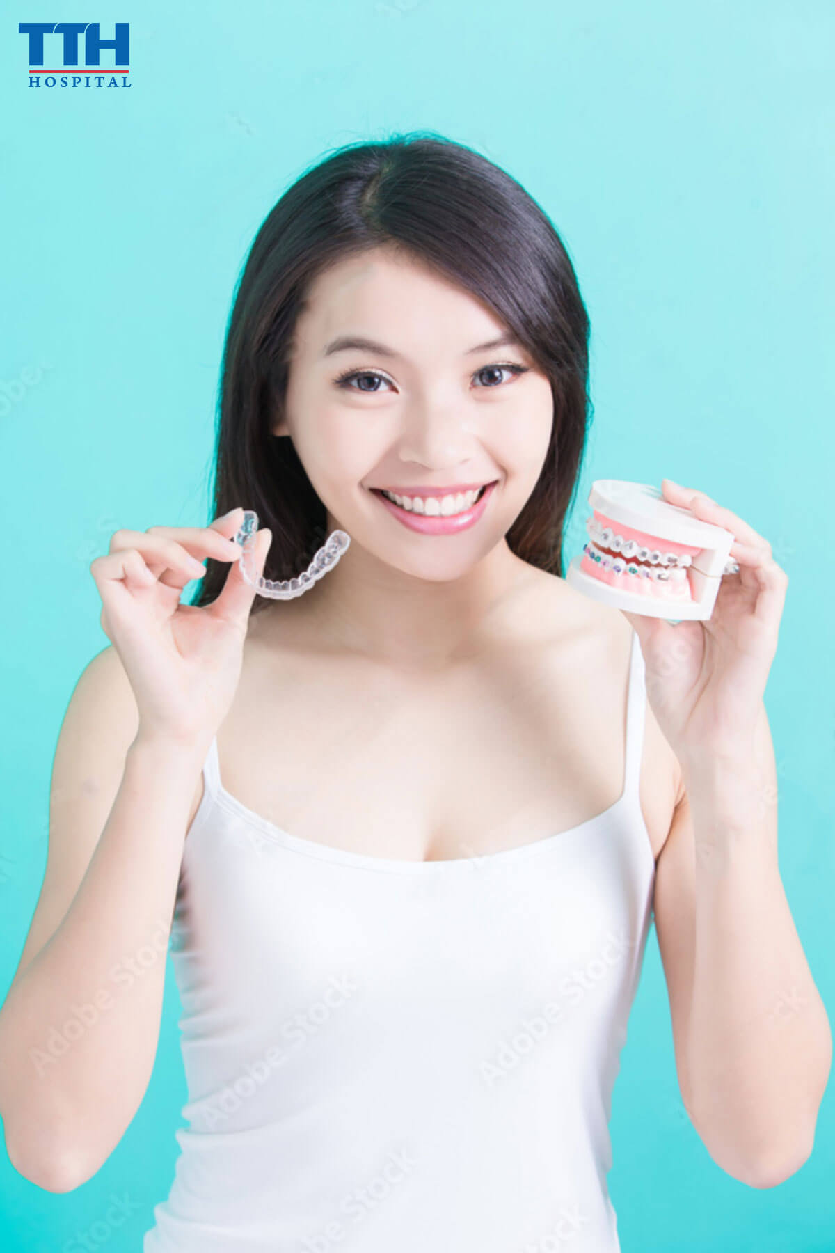 Niềng răng tại Vinh, Nghệ An khắc phục nụ cười hở lợi