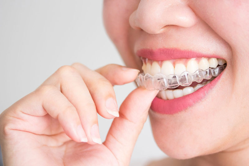 Niềng răng trong suốt - Xu hướng chỉnh nha thế hệ mới