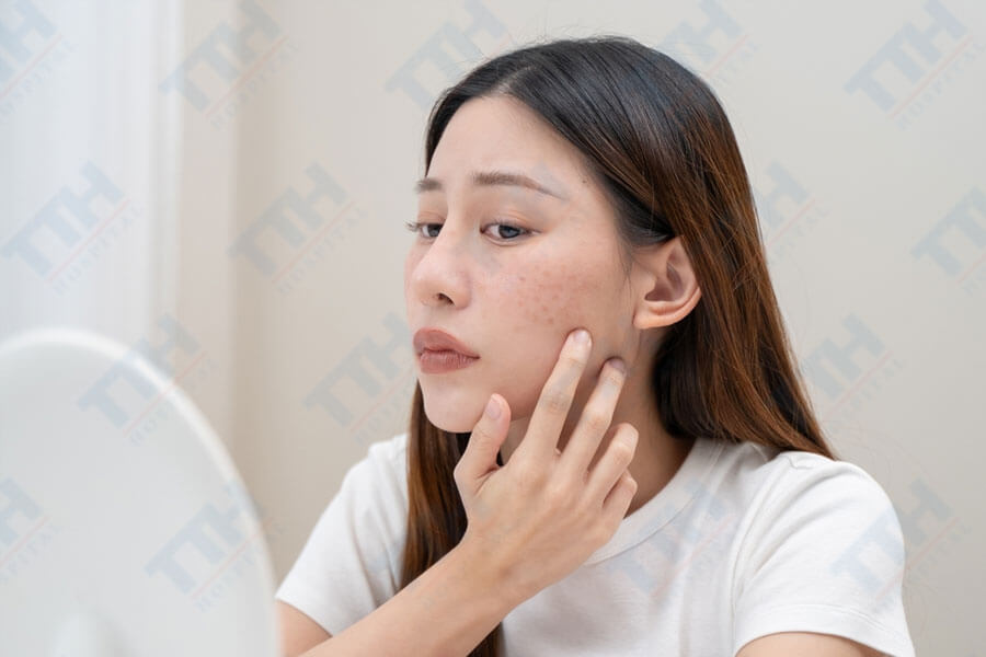 Phân biệt nám cánh bướm với các loại nám khác