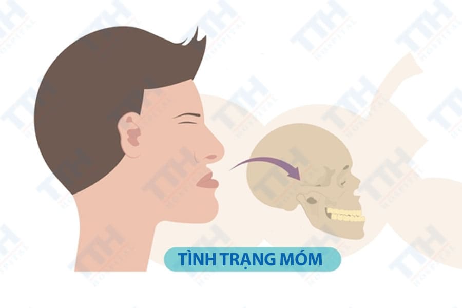 Phân loại và nguyên nhân móm