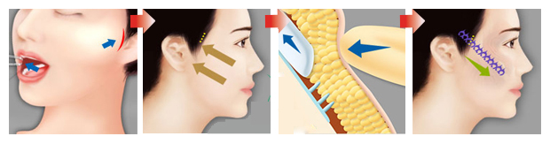 I. PHƯƠNG PHÁP THỰC HIỆN NÂNG GÒ MÁ