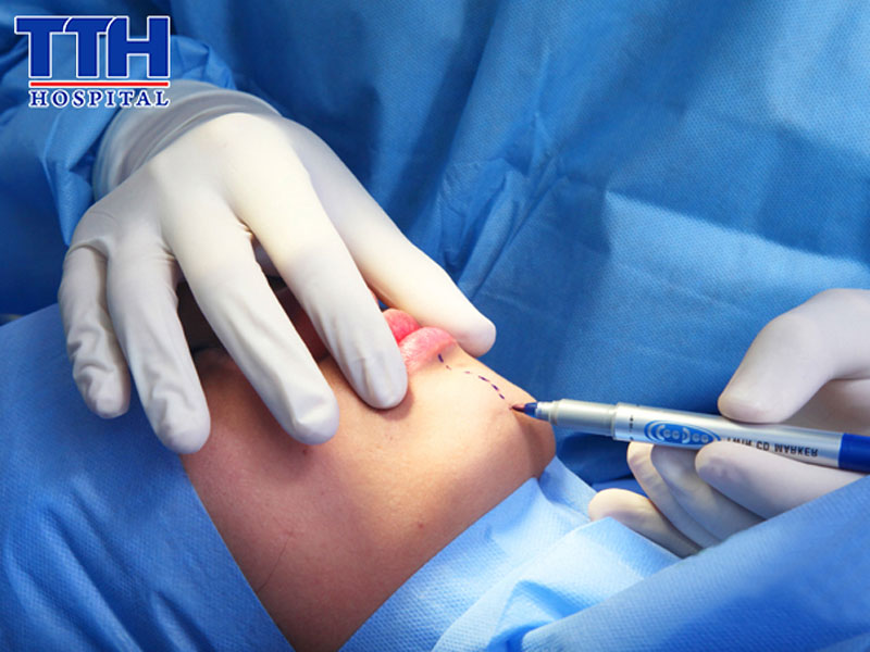 Phẫu thuật tạo hình cằm là gì?