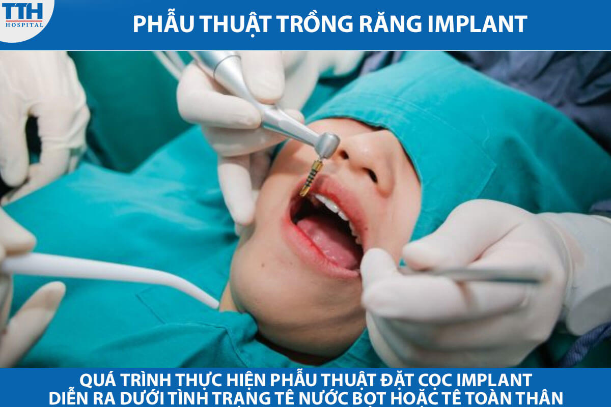 Quá trình thực hiện phẫu thuật trồng răng Implant