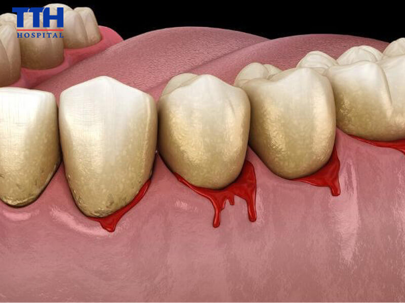 Vì sao nên lấy cao răng định kỳ?