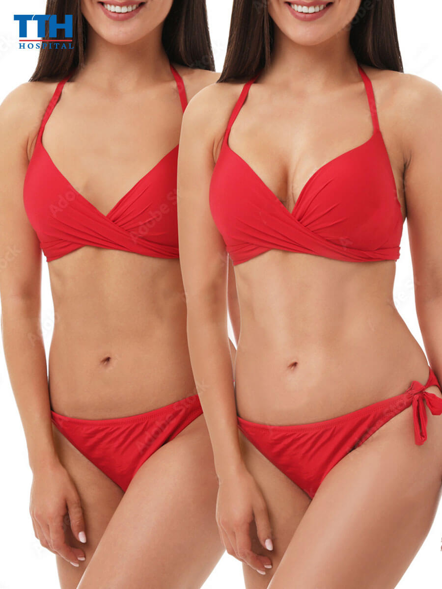 Phương pháp Nâng ngực Extra Plus