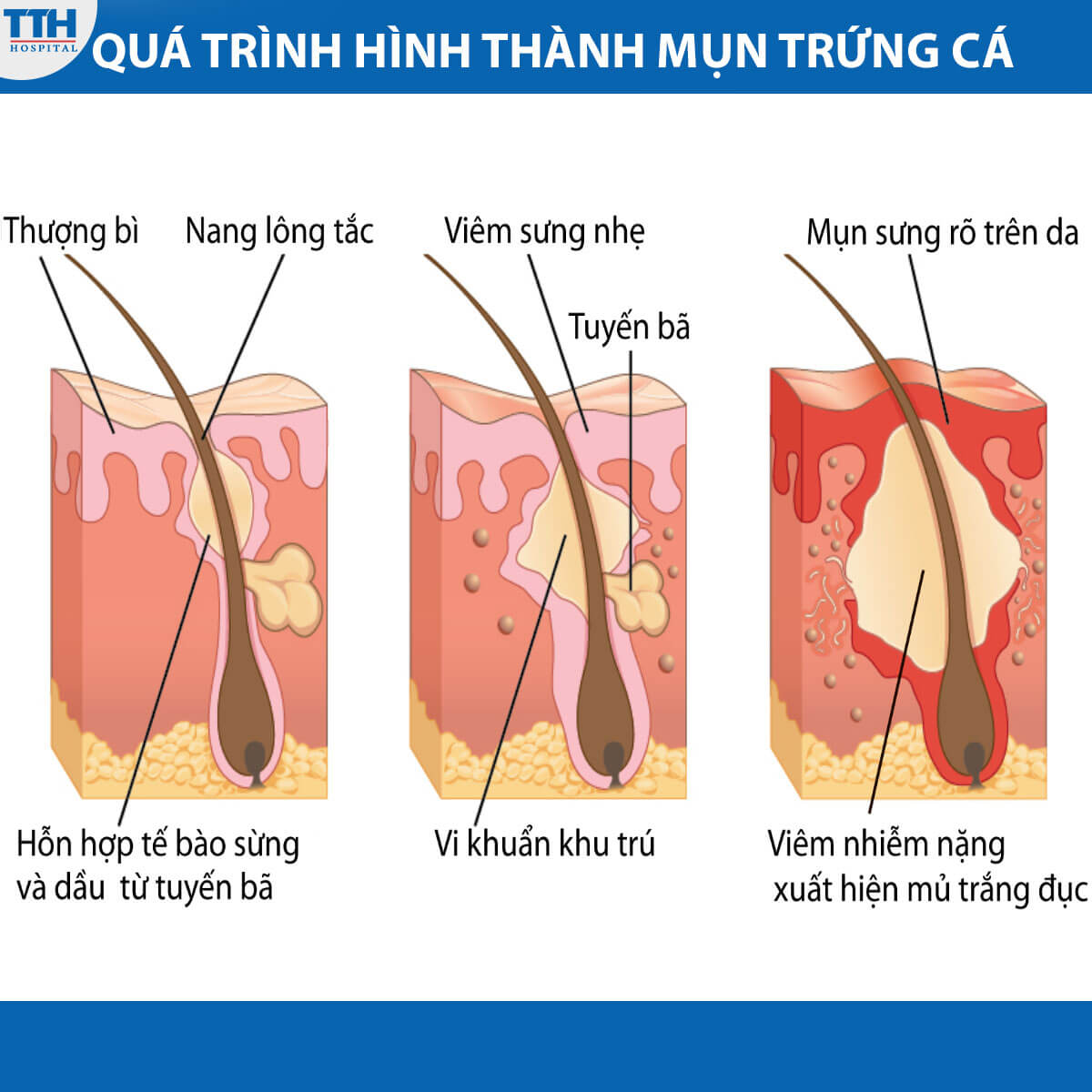 Quá trình hình thành mụn trứng cá